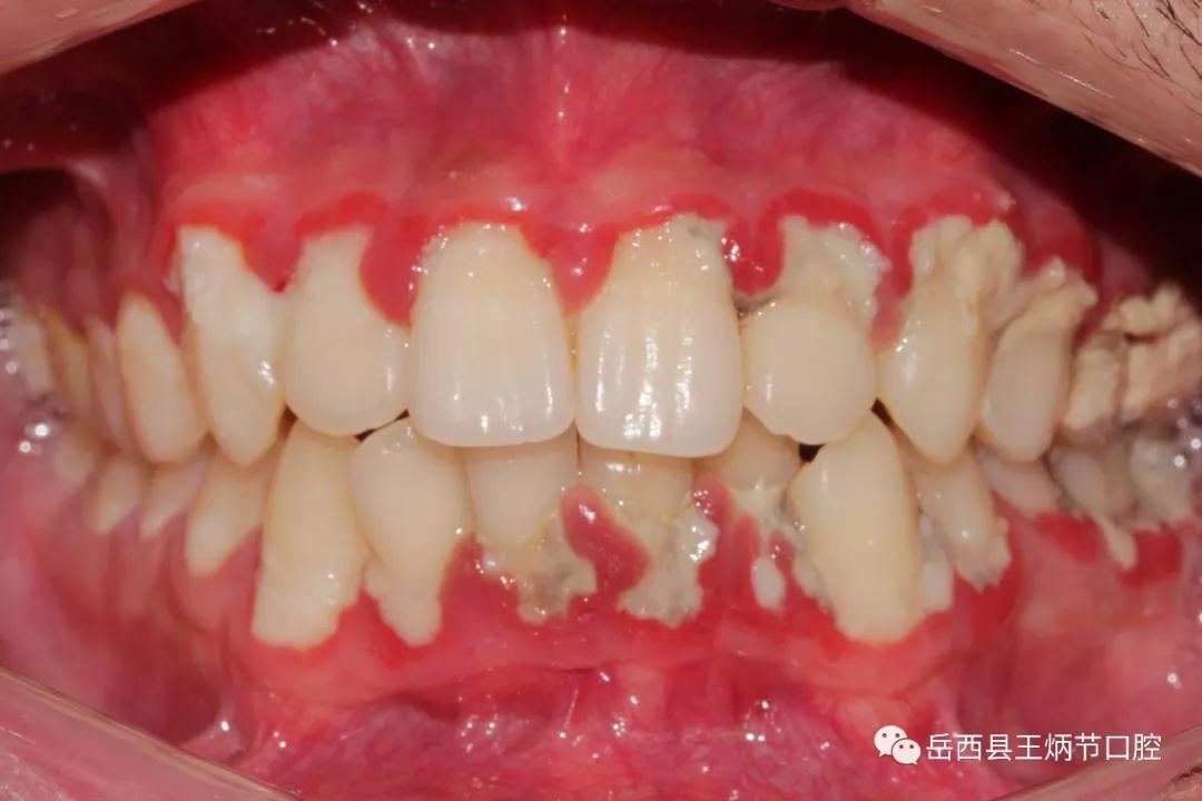 牙龈炎症红肿出血,牙龈增生,牙结石堆积,口腔异味严重