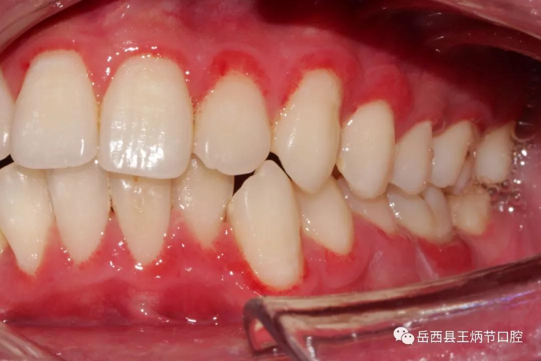 牙周科病例展示—您所不知的牙周
